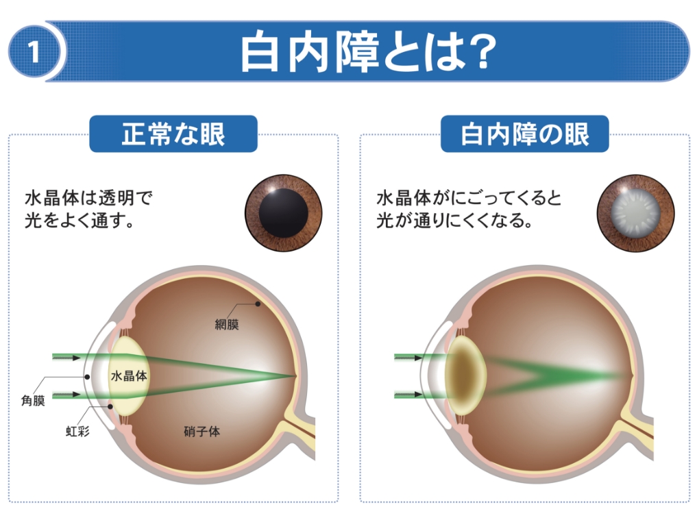 白内障について