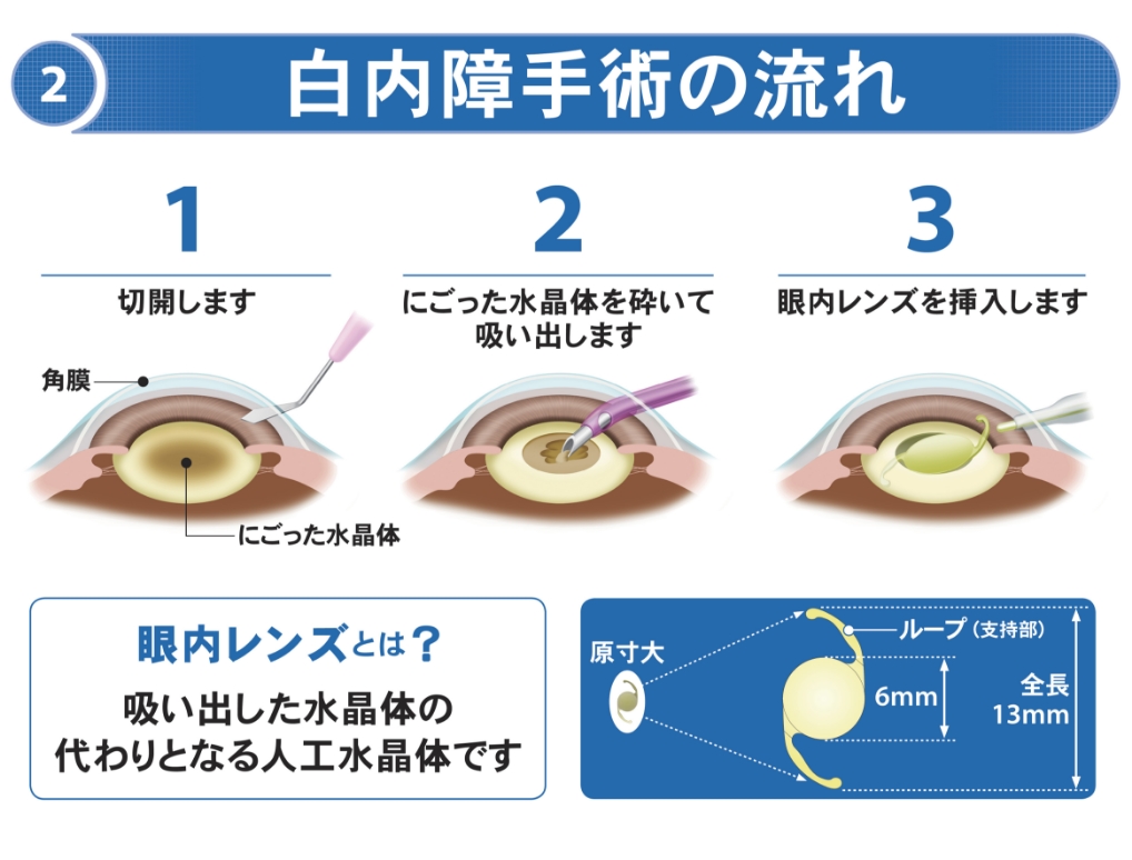 白内障の手術