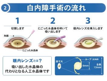 白内障の手術_SP